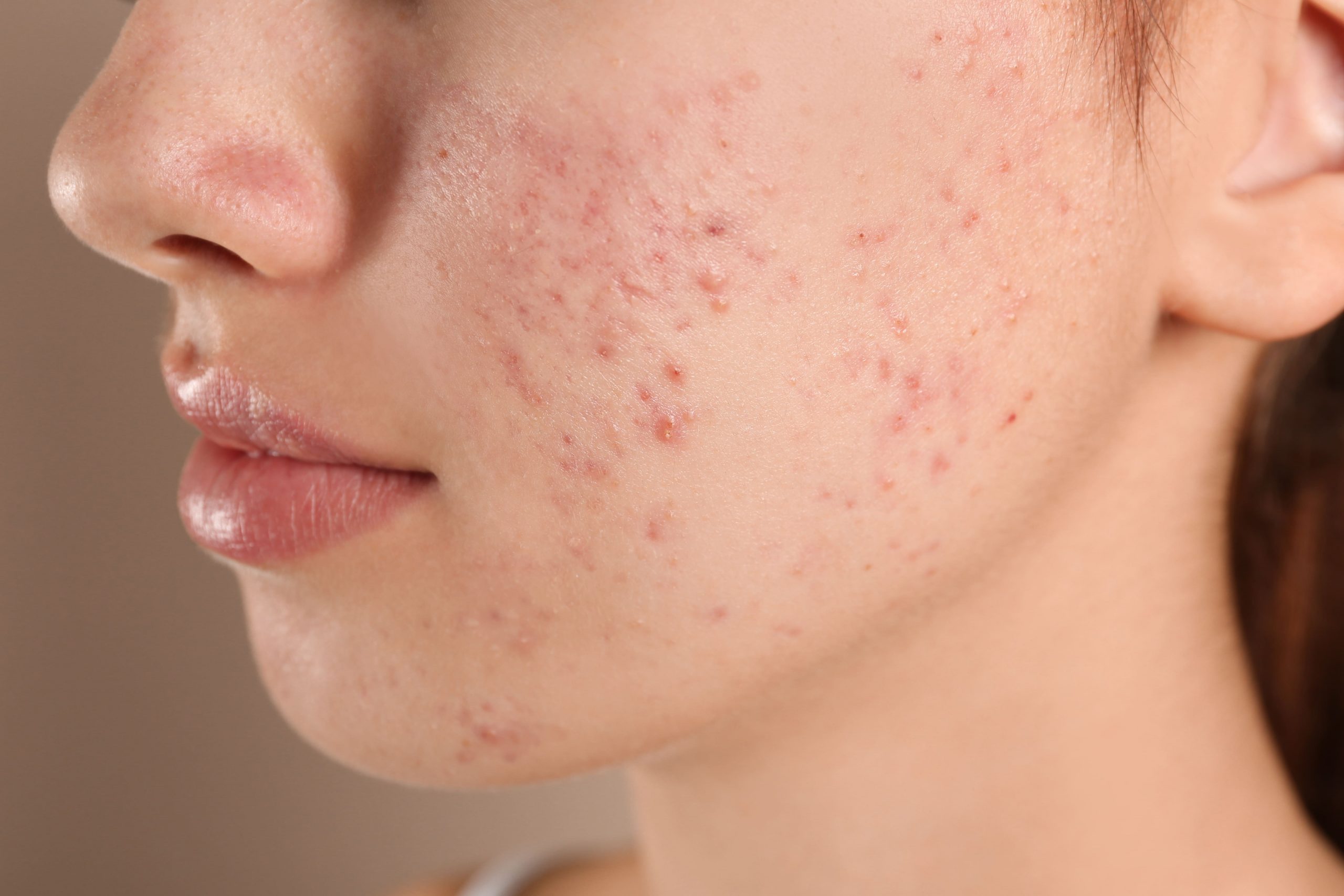 How To Get Rid of Hormonal Acne