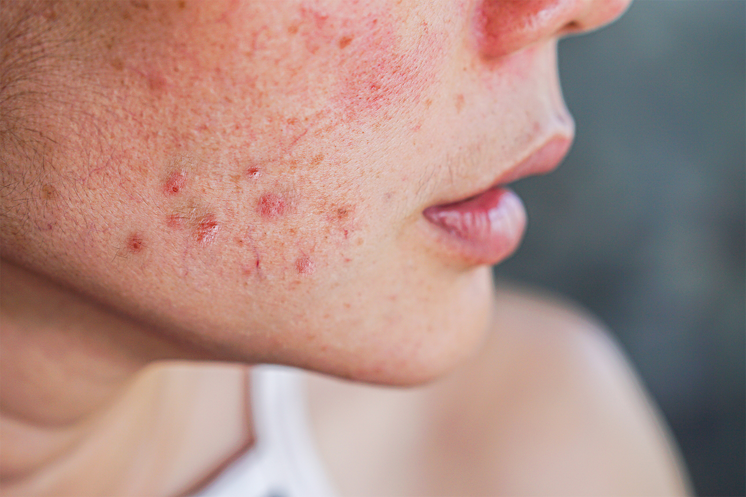Which Vitamin B Is Good For Acne?